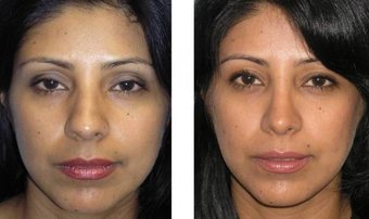 Rhinoplasty before 161404