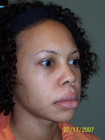 Rhinoplasty 368023