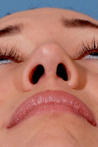 Rhinoplasty after 91602