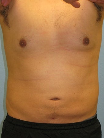 Liposuction Male after 575522