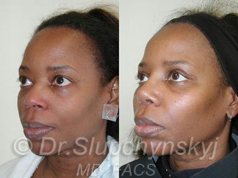 African American Rhinoplasty 525625