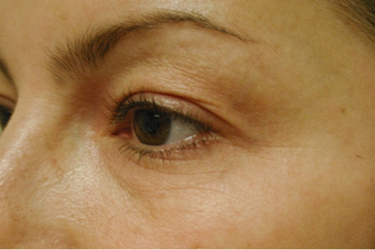Laser eyelift after 129023