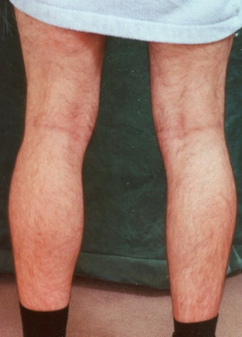 Men's Calf Augmentation before 519062