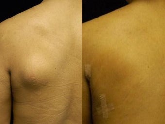 Lipoma Removal with Smartlipo Triplex before 600029