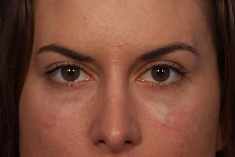 Restylane to Tear Troughs (under eyes) after 308348