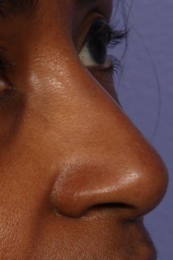 Restylane - Nose after 309233