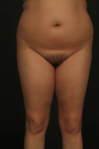 Liposuction before 315578