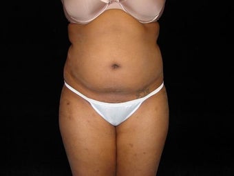 Liposuction Abdomen, Waist, Flanks and Dorsal Roll before 203518