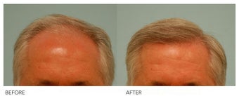 Hair Transplant before 140427