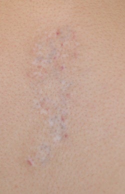 Long Beach Laser Tattoo Removal after 203259