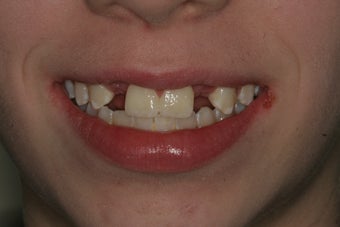 Aesthetic Implants before 213052