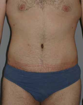 Male Abdominoplasty after 586638