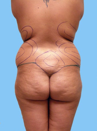 Liposuction before 177446