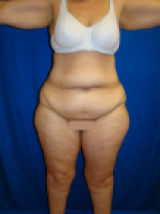 Extended Tummy Tuck, Liposuction, before 495158