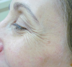 Botox for crow's feet before 383411