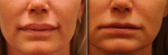 Upper and Lower Lip Reduction before 515448
