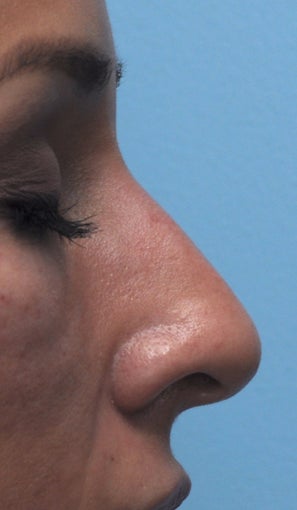 Non Surgical Rhinoplasty after 407867
