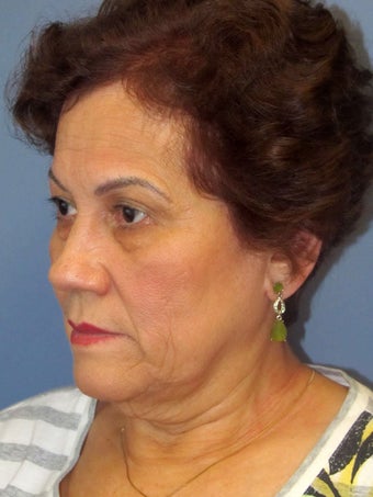 Brow Lift 505142