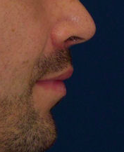 Lip Lift 635462