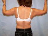 Arm Lift after 356563