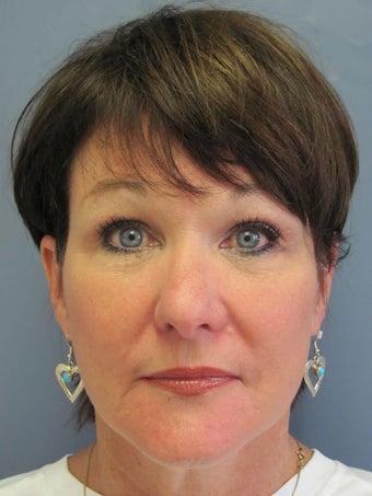 Neck Lift, Platysmaplasty after 634733