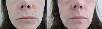 SmartXide Fractional CO2 Resurfacing after 387845