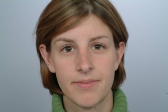 otoplasty after 358567