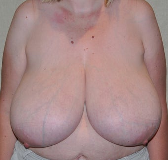 Breast Reduction before 521074