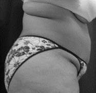 Tummy Tuck, Liposuction 402480