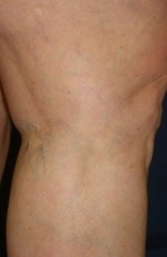 Leg Vein Sclerotherapy after 370428