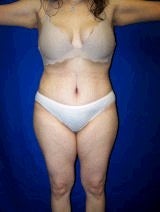 Extended Tummy Tuck Surgery (Tummy Tuck with Back Lift) after 147831