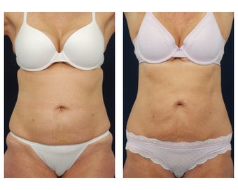 Liposuction before 495485