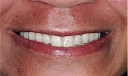 Dental Implants after 262214