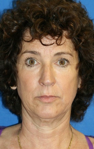 Facelift, Lateral Browlift, Fat Transfer, Chemical Peel before 399966