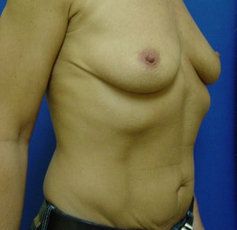 Breast Augmentation Transaxillary before 316997