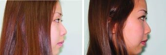 Double eyelid surgery suture 548949