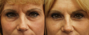 Blepharoplasty 164763