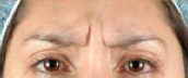 BOTOX before 284360