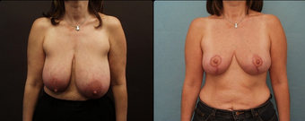 Breast Reduction before 160575