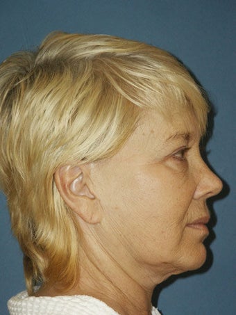 Facelift, Endoscopic Browlift, Upper and Lower Blepharoplasty with canthopexy, Perioral and Glabellar Dermabrasion before 248865