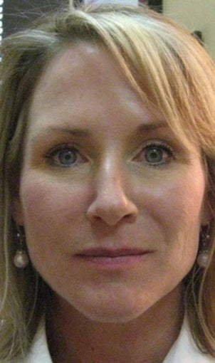Juvederm Injection to Nasolabial Folds after 312888