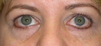 Restylane for eyes before 374299