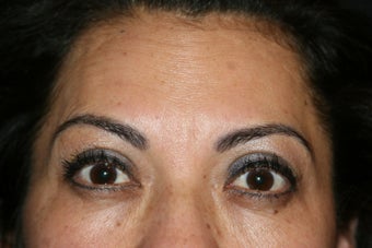 Botox after 584362