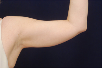 Liposuction before 397170