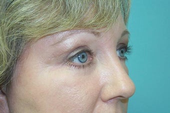 Upper and Lower Lid Blepharoplasty and Cheeklift after 148578