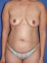 Tummy Tuck Surgery (abdominoplasty) and Breast Implants before 139135
