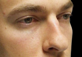 Rhinoplasty before 114369