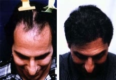 Hair replacement with Fleming/Mayer flap after 143620