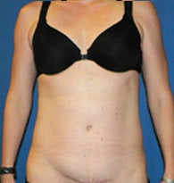 Mini-Abdominoplasty with VASER liposuction 384685