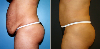 Tummy Tuck (Abdominoplasty) with Liposuction 262729